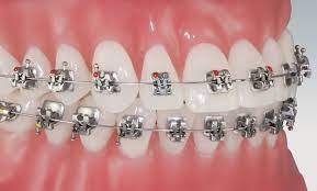 Clip on braces for teeth. Smart Clip In Dubai Uae
