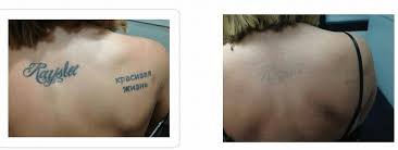 We have a custom built mercedes sprinter mobile tattoo studio that is registered and licensed in its own entirety according to miscellaneous provisions act with working practices laid out in the tattoo toolkit. Pico Laser Tattoo Removal Tattoo Removal Birmingham Solihull Medical Cosmetic Clinic