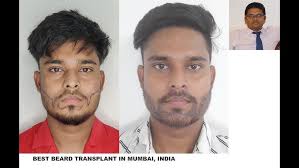Best beard transplant