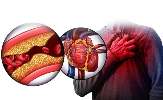 Kiểm soát mỡ máu và bảo vệ sức khỏe tim mạch
