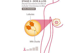 This stage describes cancer in situ, which means in place. stage 0 cancers are still located in the place they started and have not spread to this stage of cancer is often highly curable, usually by removing the entire tumor with surgery. Breast Cancer Hospital In Thane Breast Cancer Stage 0 And Stage 1