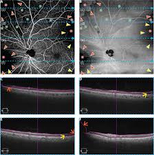 Qualitative risk analysis involves numerically analyzing the impacts of identified risks d. Controlling For Artifacts In Widefield Optical Coherence Tomography Angiography Measurements Of Non Perfusion Area Scientific Reports