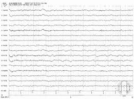 Focal Eeg Abnormalities Neupsy Key