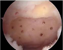 Microfracture Chondroplasty Bone And Spine