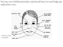 In another medical condition, peroxisomal disorder, a flat nasal bridge came with the associated epicanthal. Metabolic Disorders Inborn Errors Of Metabolism Dr Abdullah