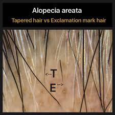Check spelling or type a new query. Blog Of A Hair Loss Physician Alopecia Areata Comparison Of Tapered Hair And