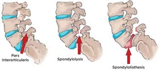 This is your first post. Pars Interarticularis Anatomy And Significance Bone And Spine