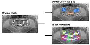 Capture sensor devices used in dentistry fall into two categories: Applied Sciences Free Full Text Automatic Tooth Detection And Numbering Using A Combination Of A Cnn And Heuristic Algorithm Html