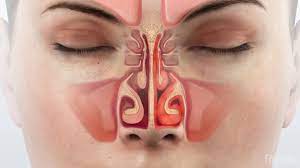 Runny Nose Chronic Rhinitis Definition Symptoms And Causes