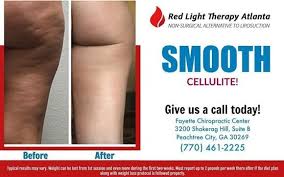 Pin On Red Light Therapy And Weight Loss