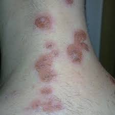 Image result for Skin Infection