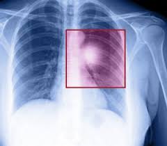 Image result for lung cancer xray