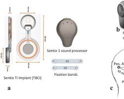 Image of Transcutaneous Bone Conduction Device
