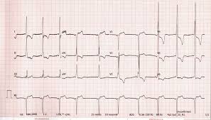 Image result for Left Ventricular Hypertrophy