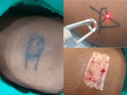 When i started working for tannan plastic surgery i discovered the surgical procedure of tattoo excision and it saved me the money and trouble of laser removal. Permanent Tattoo Removal Procedures Dr Agarwal S Clinic Siliguri