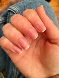 This trustworthy technique for removing fake nails is a. Remedies For Nail Pain After Removing Acrylic Nails Thriftyfun
