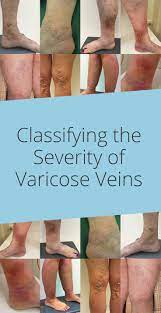 Pin On Vein Therapies
