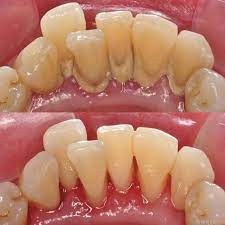 Teeth Scaling Before And After Dentalhygienist Scaleandpolish Dental Cleaning Dental Health Healthy Teeth