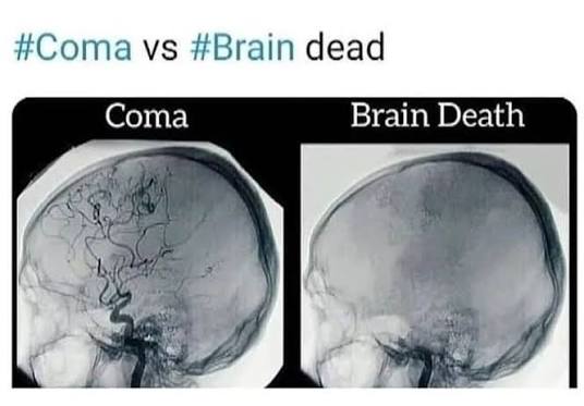 Coma Brain Vs Brain Dead - MEDizzy