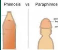 Image result for paraphimosis