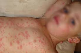 Chiar și vaccinați, copii pot face această boală, deoarece vaccinul oferă o protecție de peste 99% față de infecție și forme severe ale bolii. 63 De Copii Morti De RujeolÄ In Romania Lui 2019 Germania Èi Italia Amenzi De 3500 De Euro Pentru Nevaccinare Paula Rusu