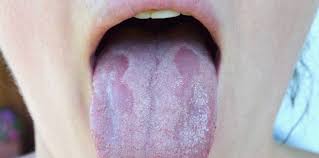 Afecteaza predominent copin in varsta de pana la 5 ani, cu incidenta crescuta in primavara si vara. Candidoza Bucala Cauze Simptome Si Tratament