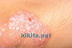 Pero la mejor forma de hacerle frente, es investigando sobre ellas. Signos Y Sintomas De Cancer De Piel No Melanoma Es Kikita Net