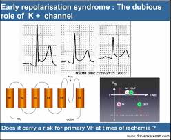 Image result for Early Repolarization