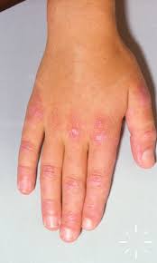 Image result for Dermatomyositis