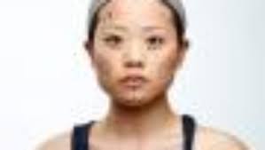 On 'de-racialisation' surgery