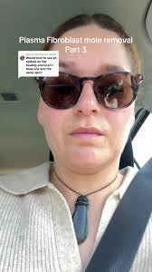 Plasma Fibroblast Mole Removal Experience and Healing Update