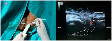 Image result for Pudendal Block