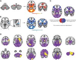 Image result for Neurologic Lesion Localization