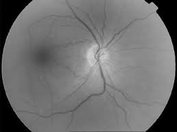A Late Presentation Of Ocular Quinine Toxicity Managed With A Combination Of Vasodilatory Treatments Eye