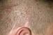 Itchy Bumps On Scalp That Won T Go Away