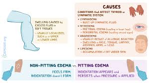 Image result for Edema Exam