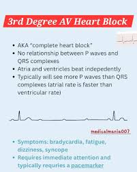 Image result for Atrioventricular Block