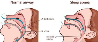 Image result for Obstructive sleep apnea image