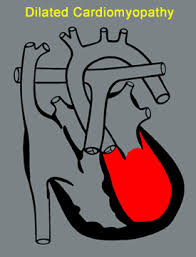 Image result for Cardiomyopathy