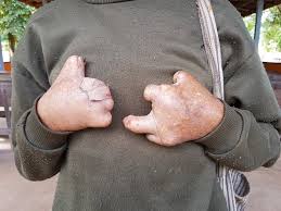 Leprosy Hansen S Disease Mdadvices Com