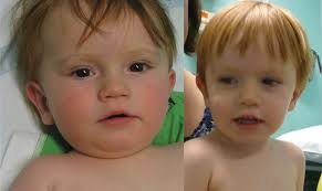 Diagnostic Yield of Whole Genome Sequencing After Nondiagnostic Exome  Sequencing or Gene Panel in Developmental and Epileptic En