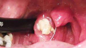 Petua menghilangkan halitosis dan mulut berbau. Gosok Gigi Berulang Kali Tapi Mulut Masih Berbau Memang Memalukan Rupanya Inilah Punca Sebenarnya Mysyiok Tv