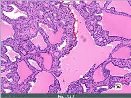 A new section on the interpretation of fine needle aspiration results in patients with thyroid nodules; Pathoma 15 3 15 7 Thyroid Flashcards Quizlet