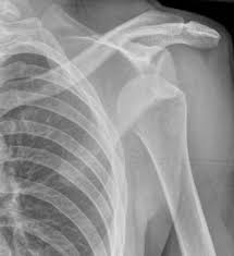 Schulterschmerzen Symptome Verletzung Sehnenruptur Arthrose Oder Entzundung Www Gelenk Doktor De