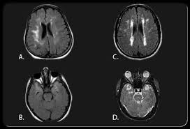 Dementia with lewy bodies or lewy body dementia is dementia caused by the presence of lewy bodies in the brain. Axial Flair Or Fluid Attenuated Inversion Recovery Image A B C And T2 Weighted D Brain Mri From Patients Wit Brain Diseases Alzheimer S Disease Dementia