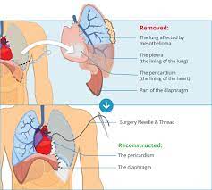 Most cases of lung cancer are associated with. Using Hot Chemotherapy For Pleural Mesothelioma Mesothelioma Guide