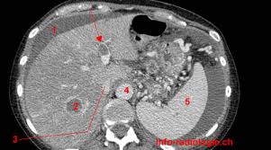Cancer Du Pancreas Multi Metastatiques Avec Embolies Pulmonaires