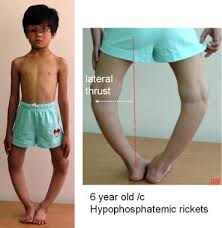Image result for Pediatric Leg Disorder