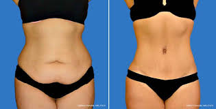 Tummy Liposuction Before And After 1 Tummy Tuck Surgery Tummy Tucks Tummy Tuck Before After