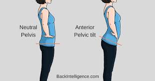 How To Fix Anterior Pelvic Tilt Posture 10 Exercises Back Intelligence Pelvic Tilt Posture Correction Exercises Posture Exercises